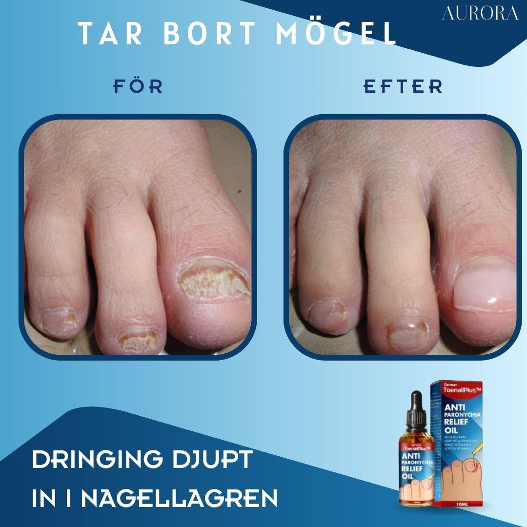 ToePerfect™ - Läker tånaglar och handnaglar | 1+1 FREE TEMPORARY - Aurora Stockholm