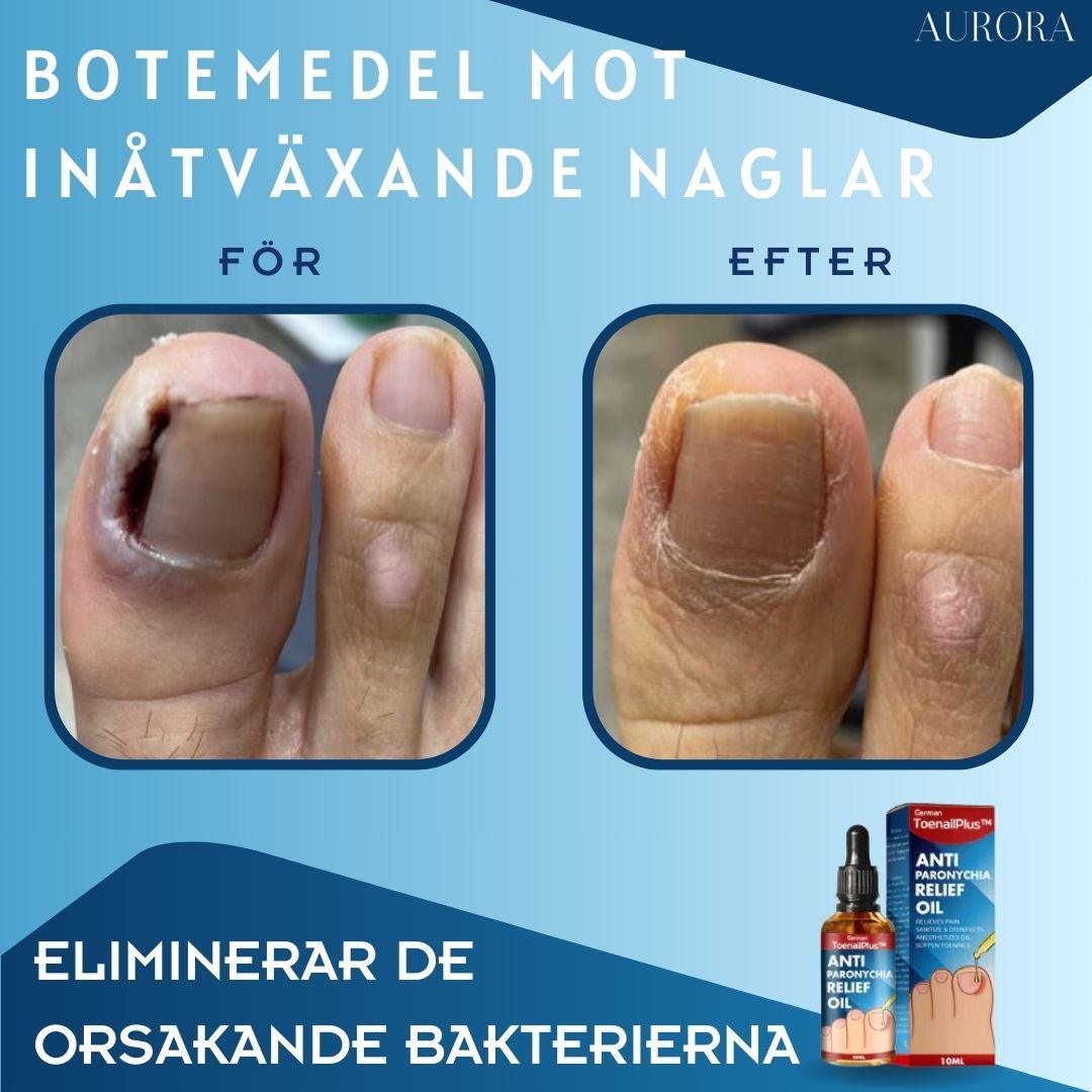 ToePerfect™ - Läker tånaglar och handnaglar | 1+1 FREE TEMPORARY - Aurora Stockholm