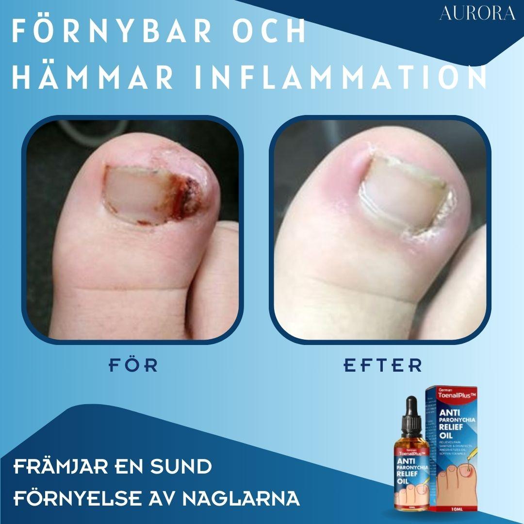 ToePerfect™ - Läker tånaglar och handnaglar | 1+1 FREE TEMPORARY - Aurora Stockholm