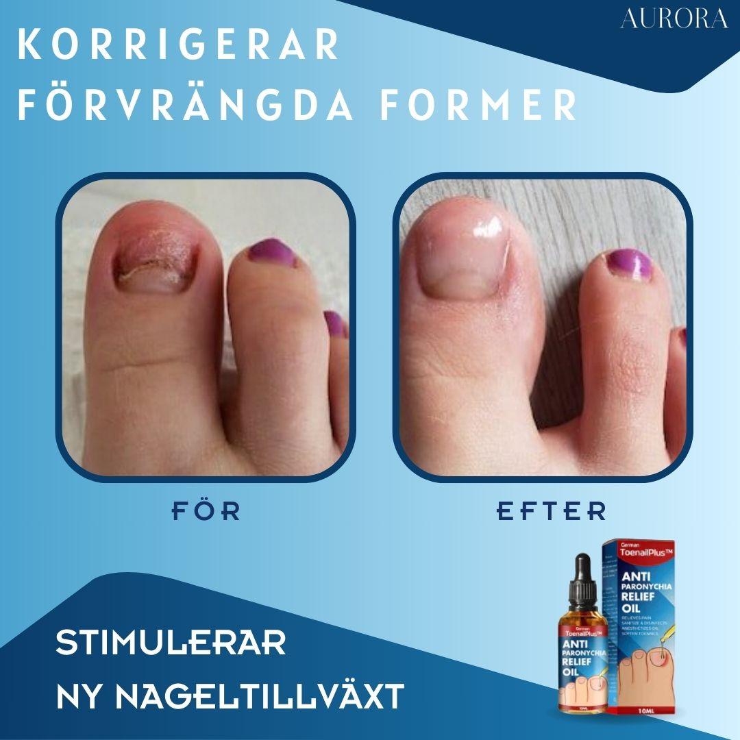 ToePerfect™ - Läker tånaglar och handnaglar | 1+1 FREE TEMPORARY - Aurora Stockholm